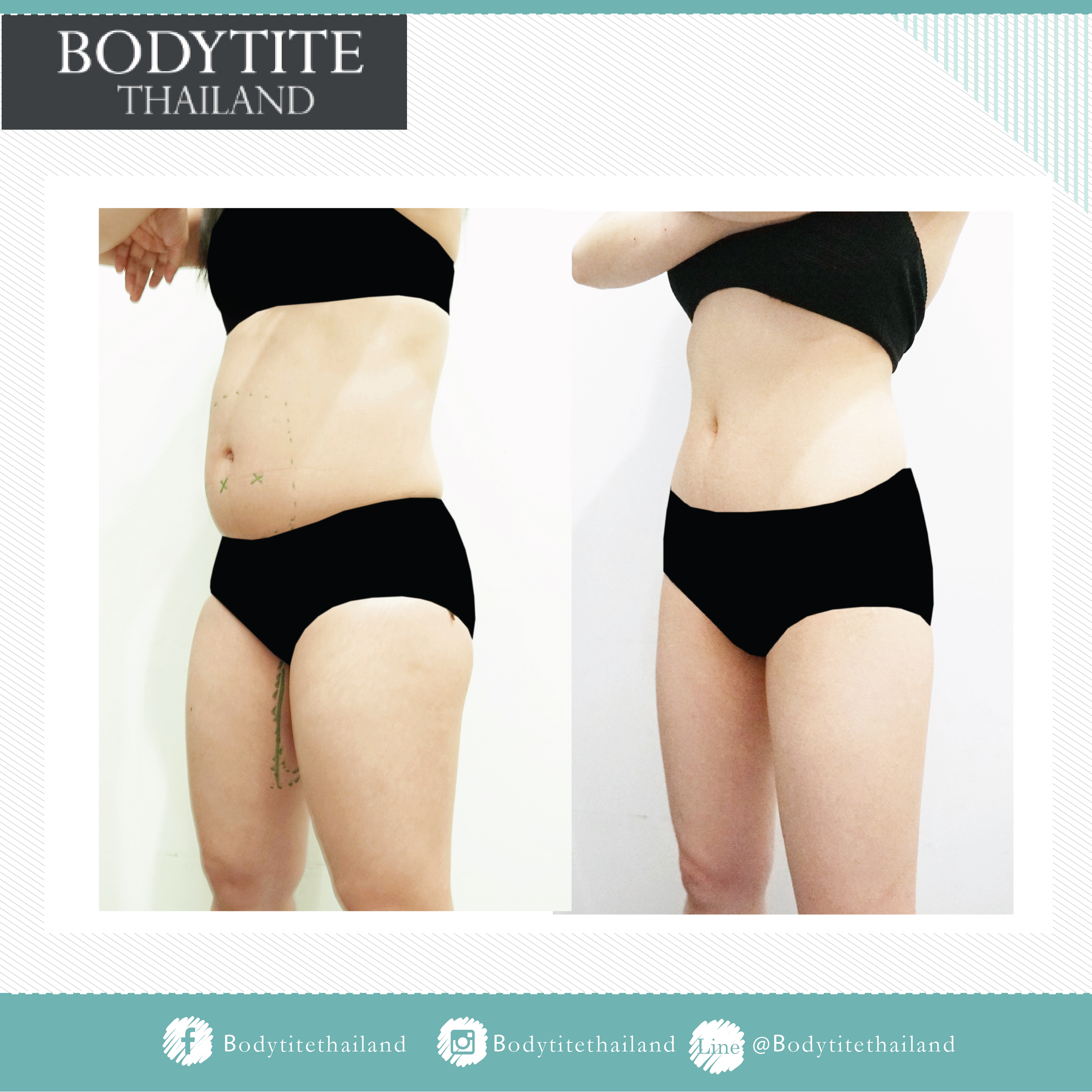 Thigh Liposuction