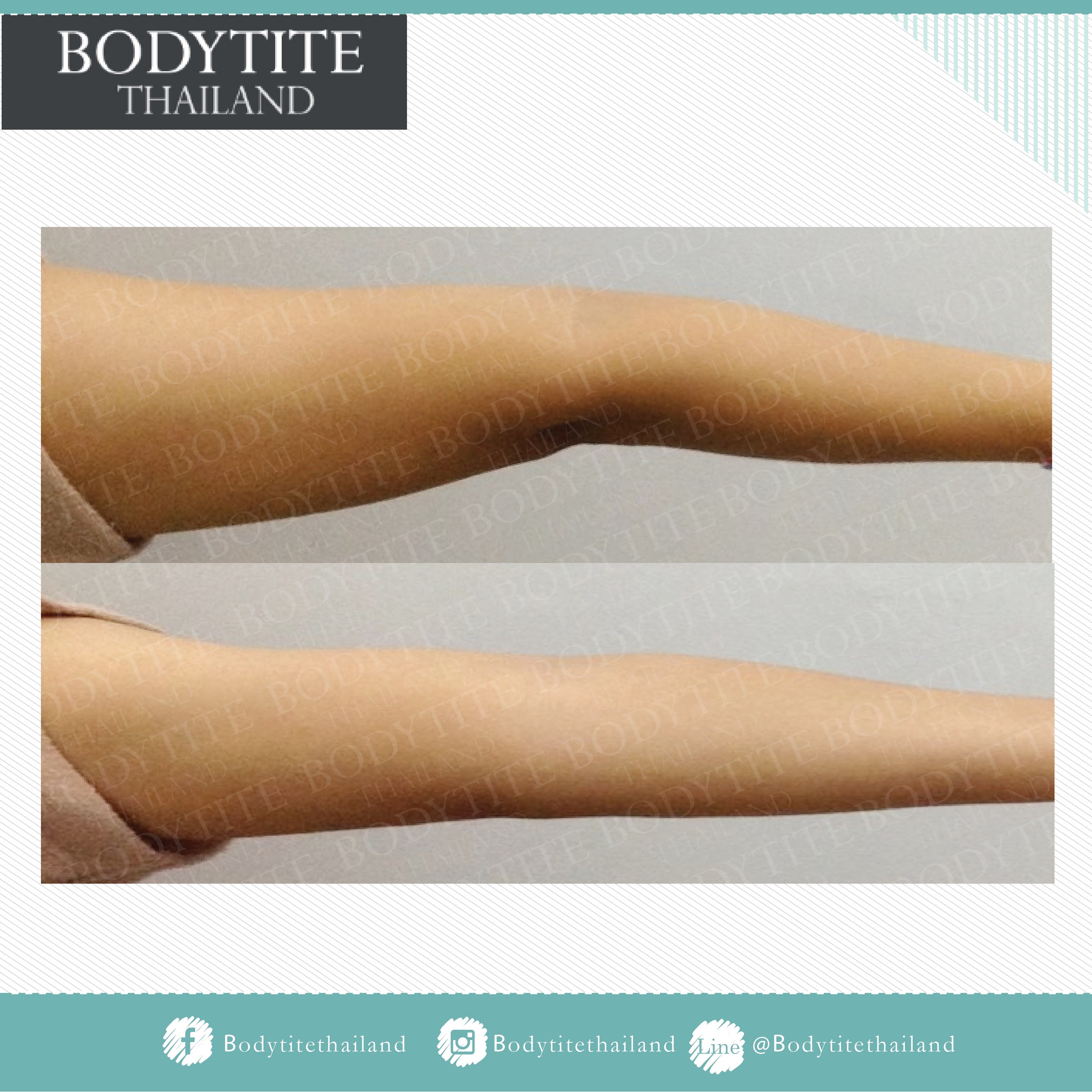 Thigh Liposuction