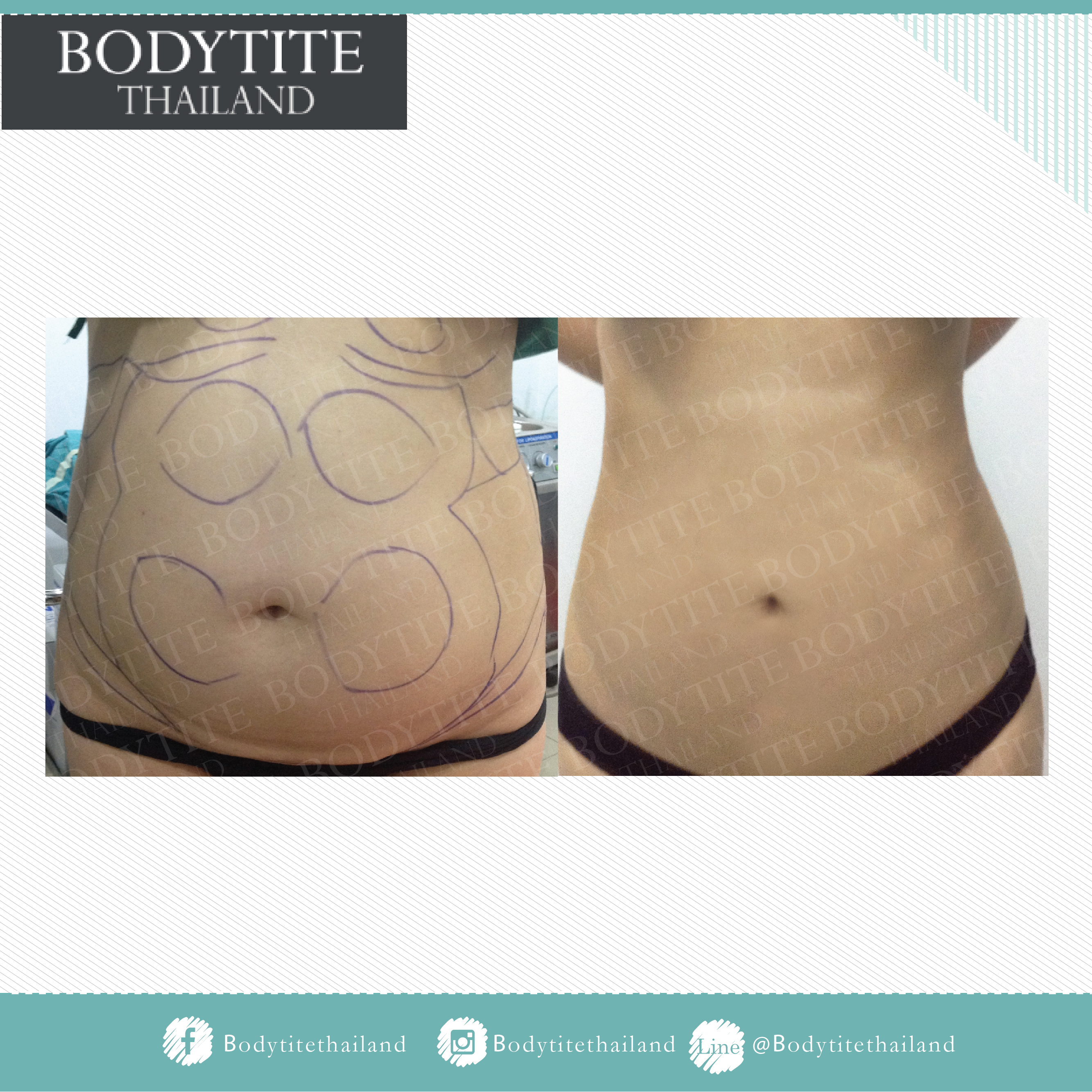 Thigh Liposuction