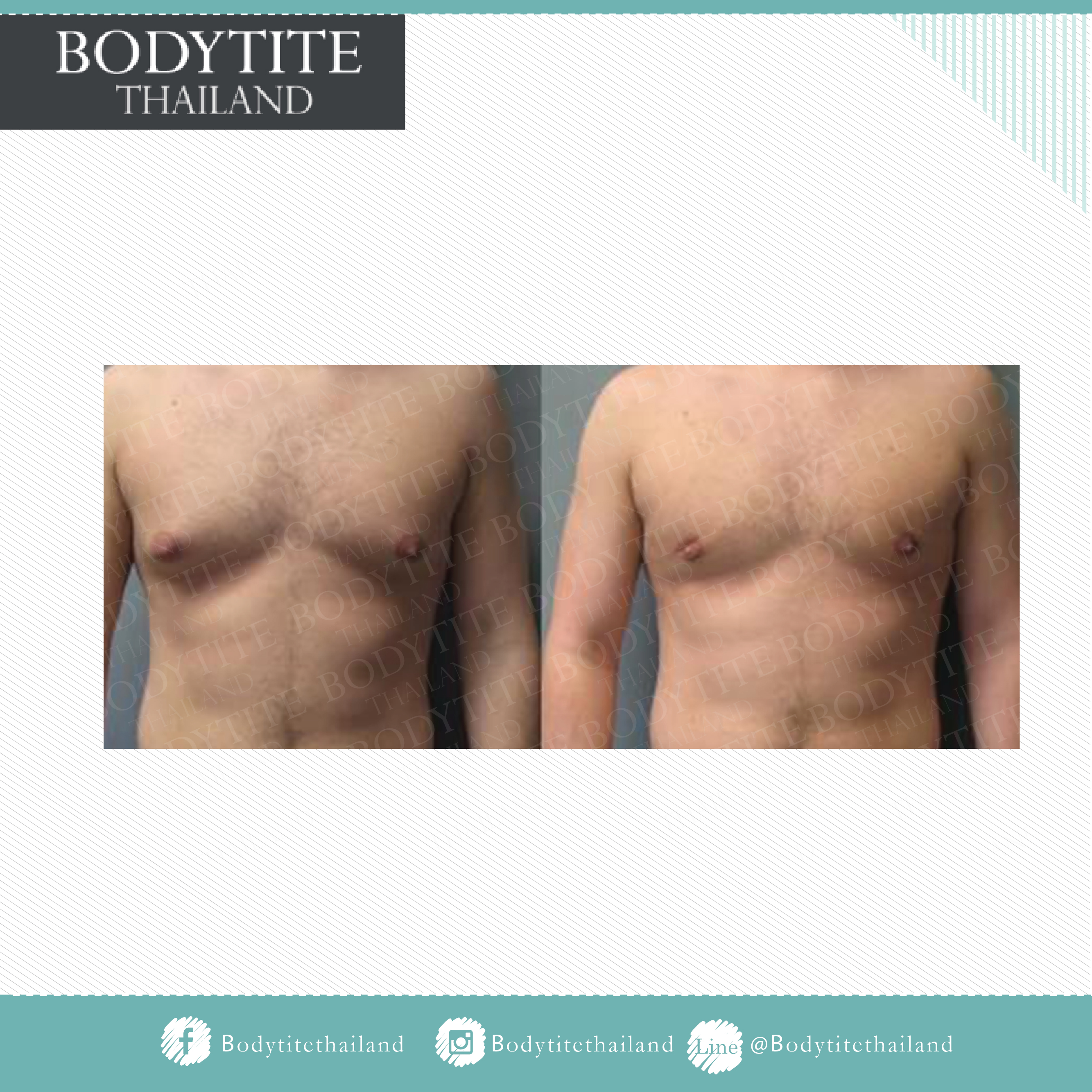 Thigh Liposuction