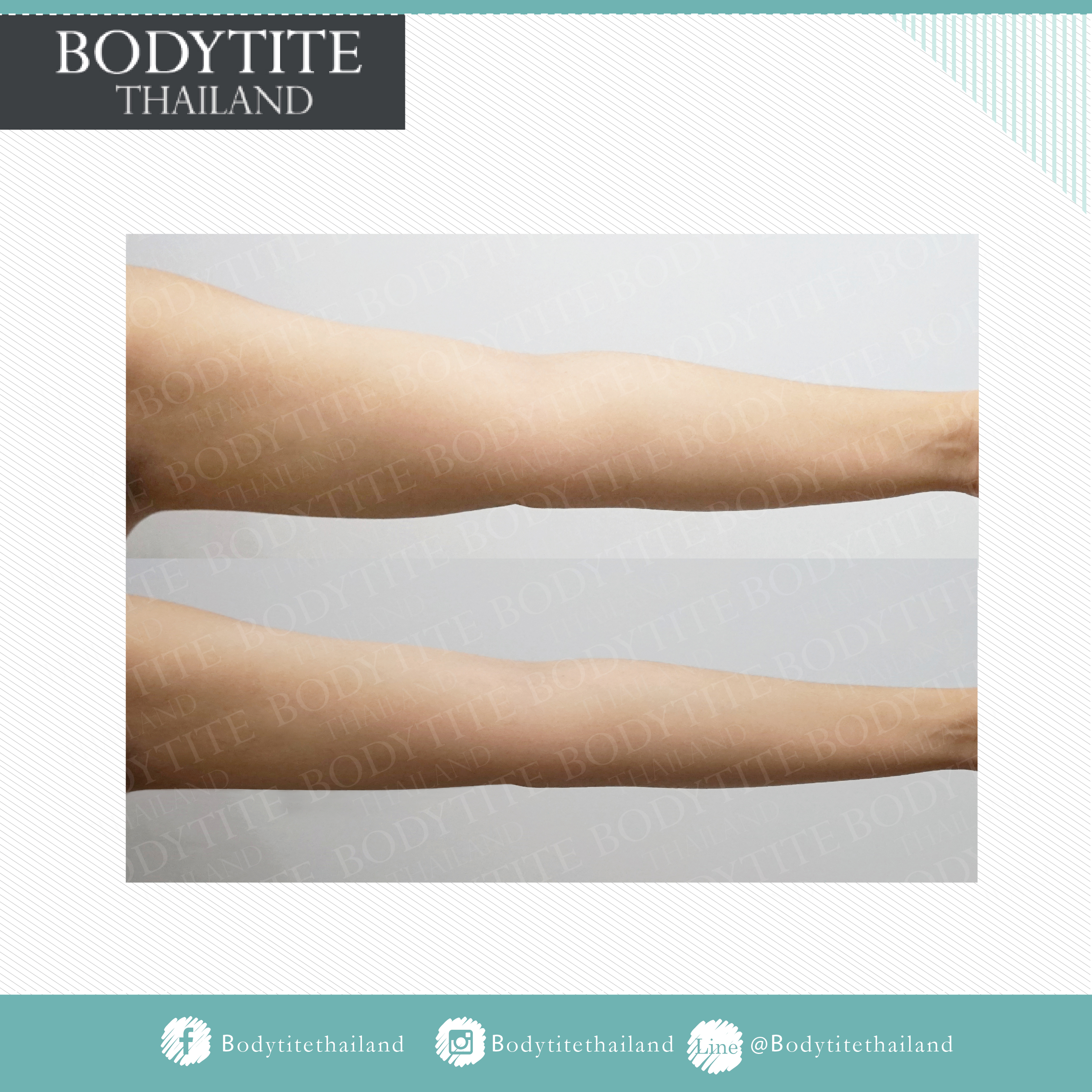 Thigh Liposuction