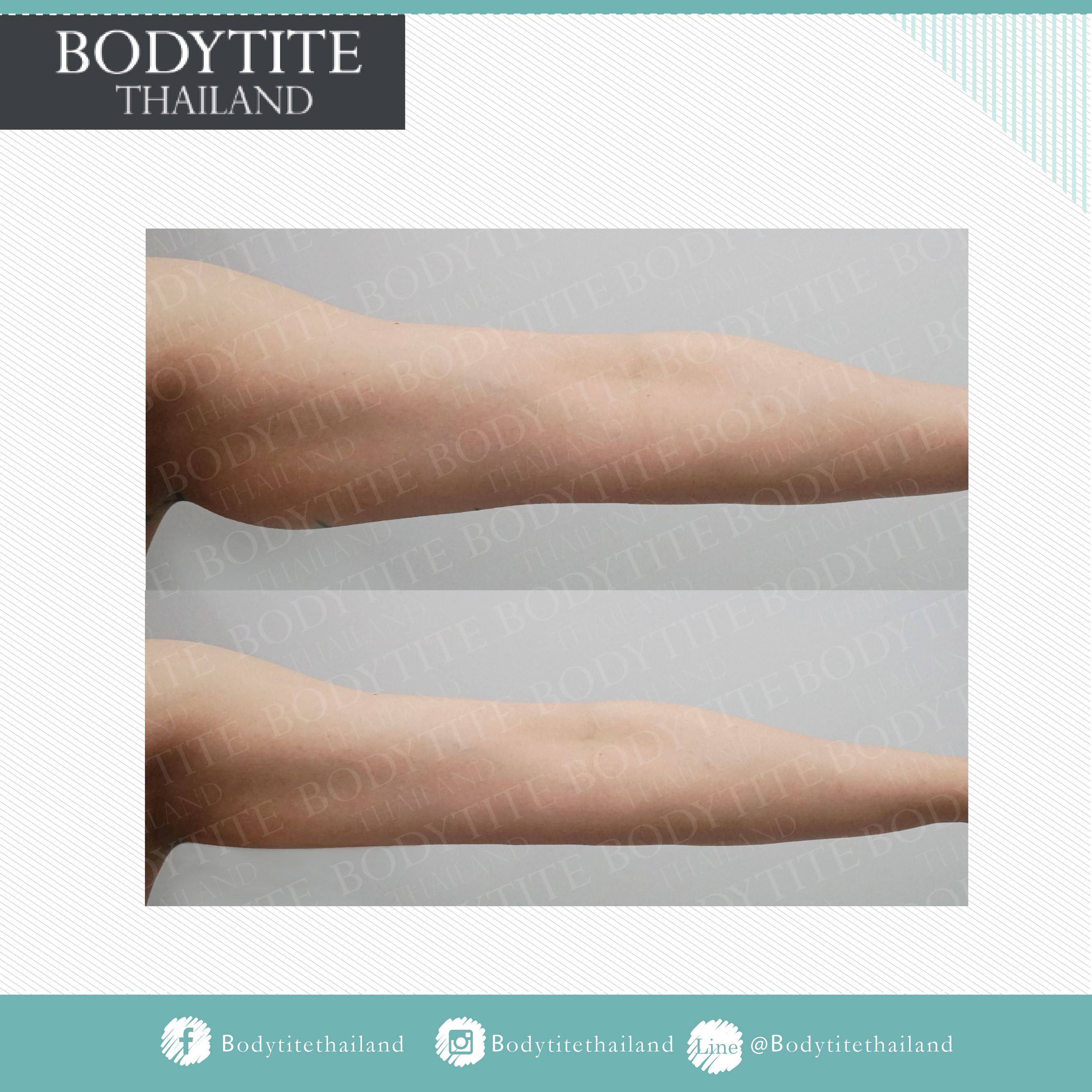 Thigh Liposuction