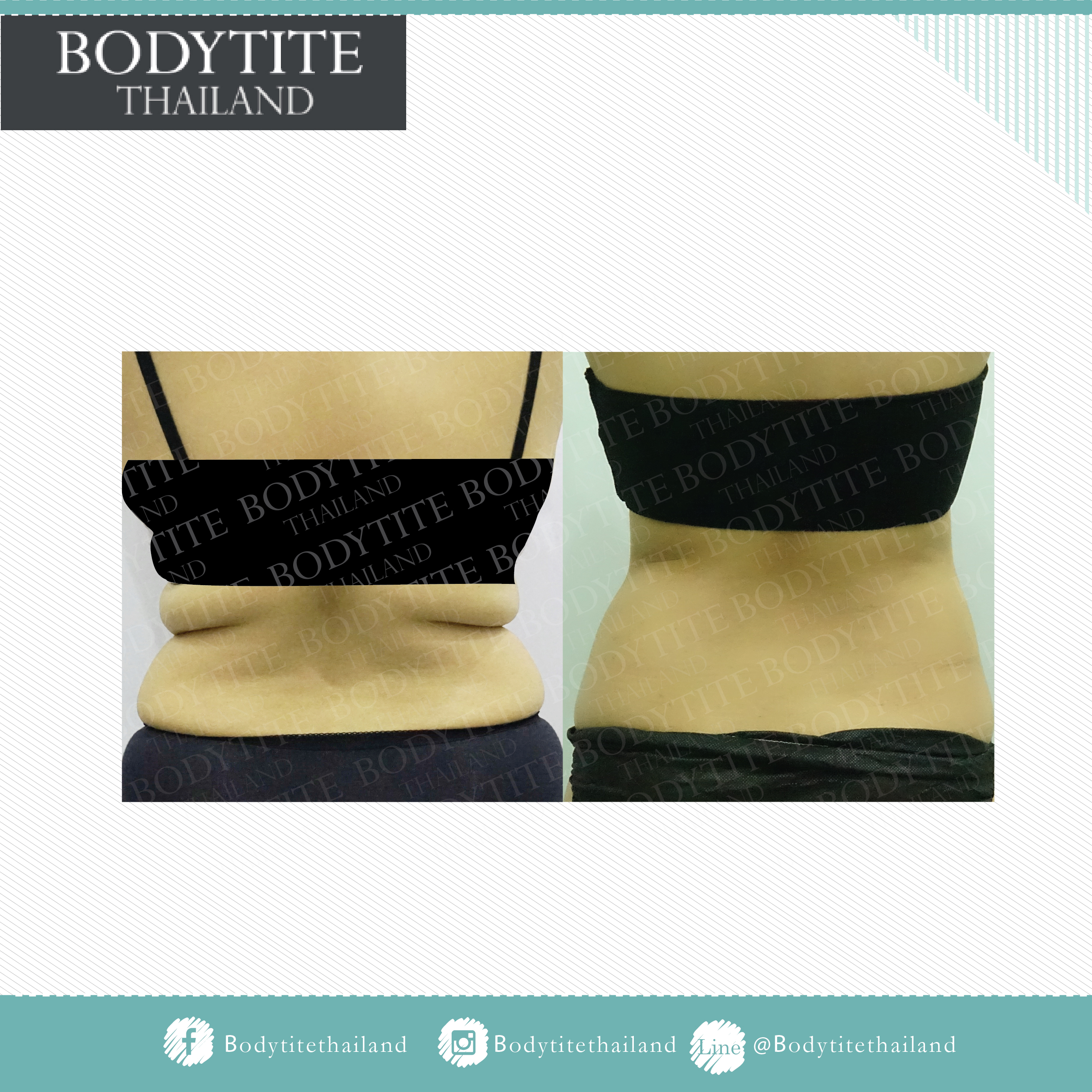Thigh Liposuction