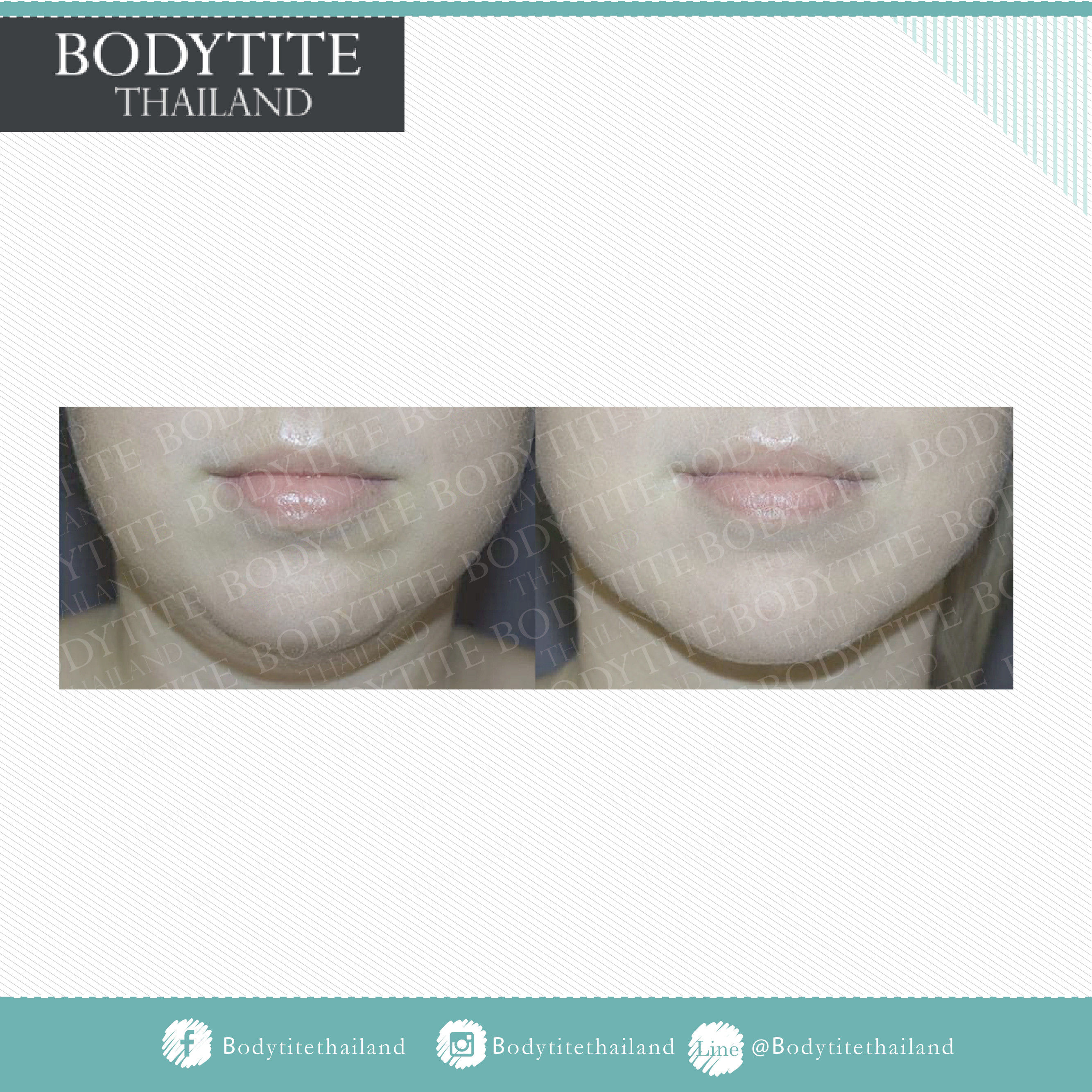Thigh Liposuction