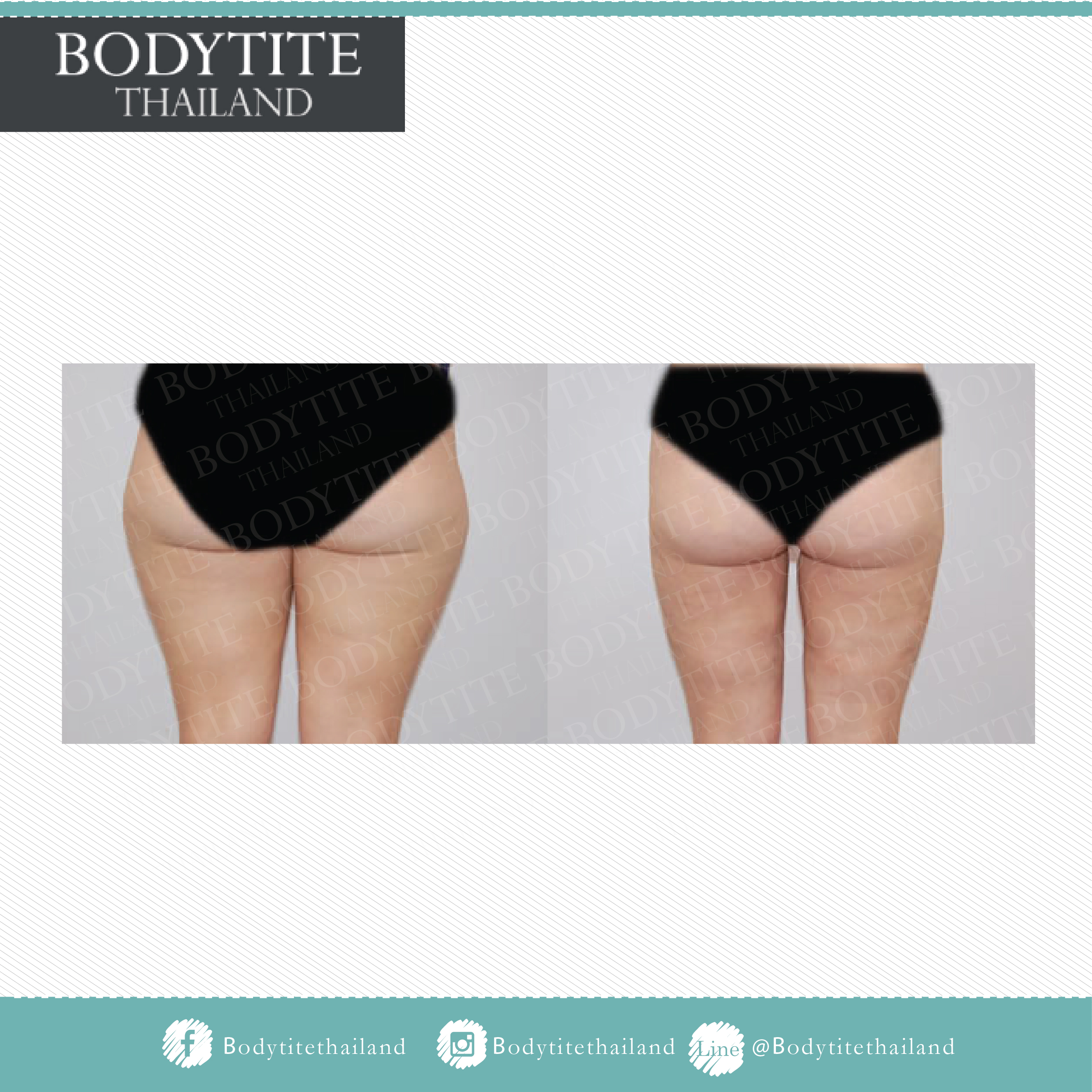 Thigh Liposuction