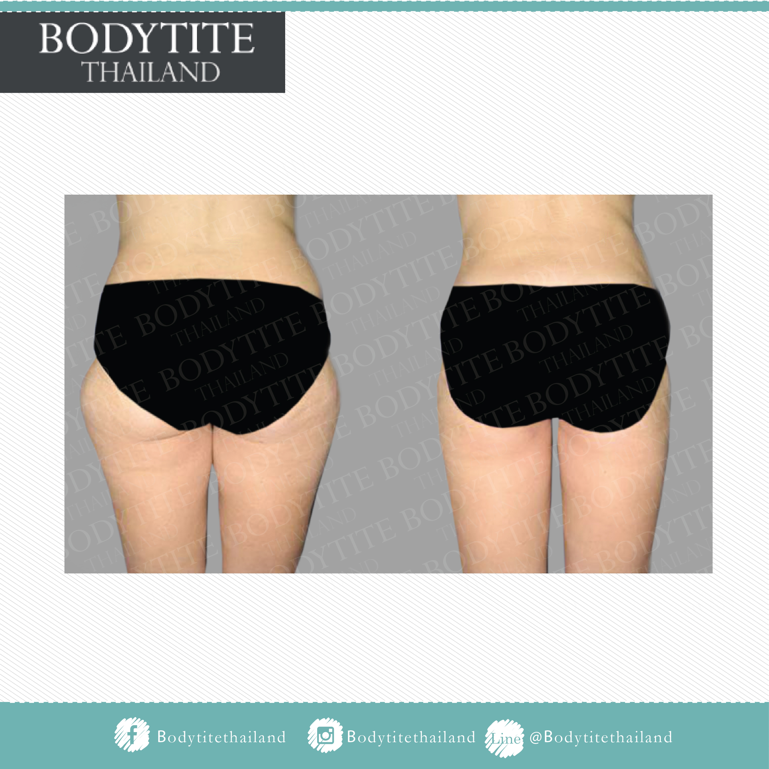 Thigh Liposuction