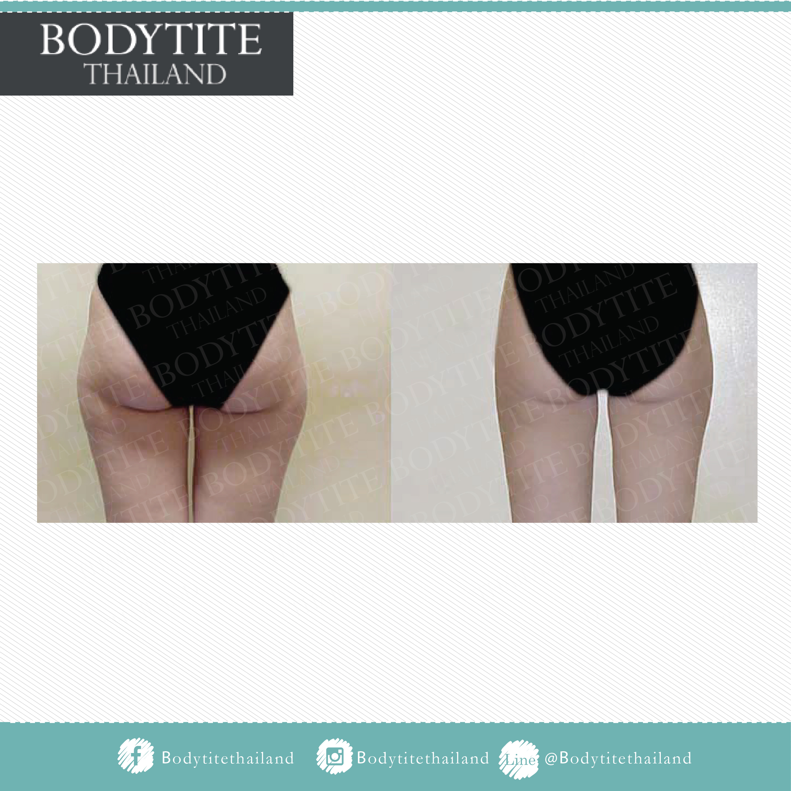 Thigh Liposuction