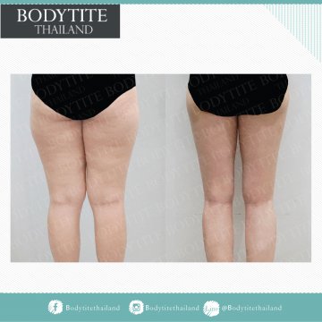 Thigh Liposuction