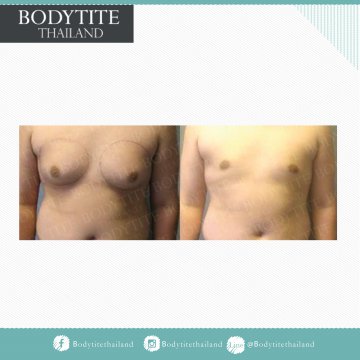 Male Breast Liposuction