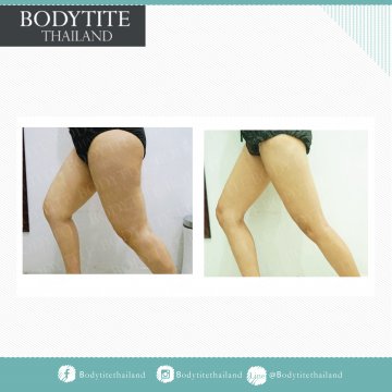 Thigh Liposuction