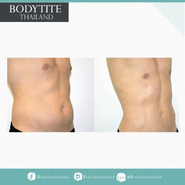Male Breast Liposuction