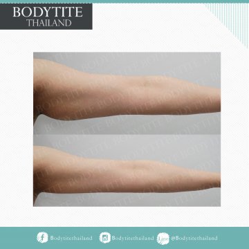 Arm Liposuction