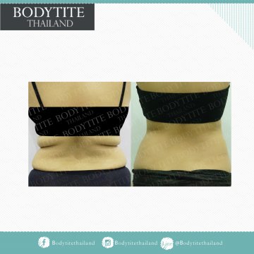 Abdomen Liposuction