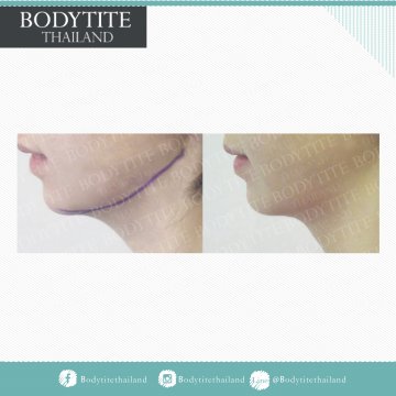 Facial Liposuction