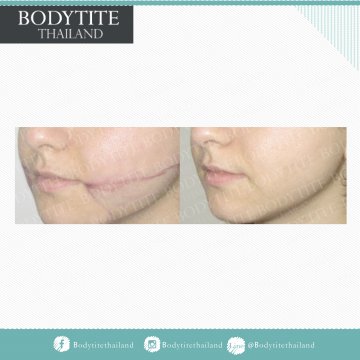 Facial Liposuction